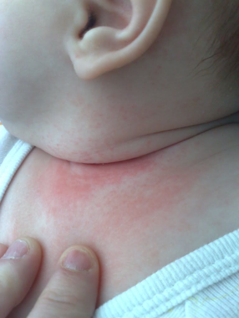 Neck Rash Sorry This Is Long Babycenter